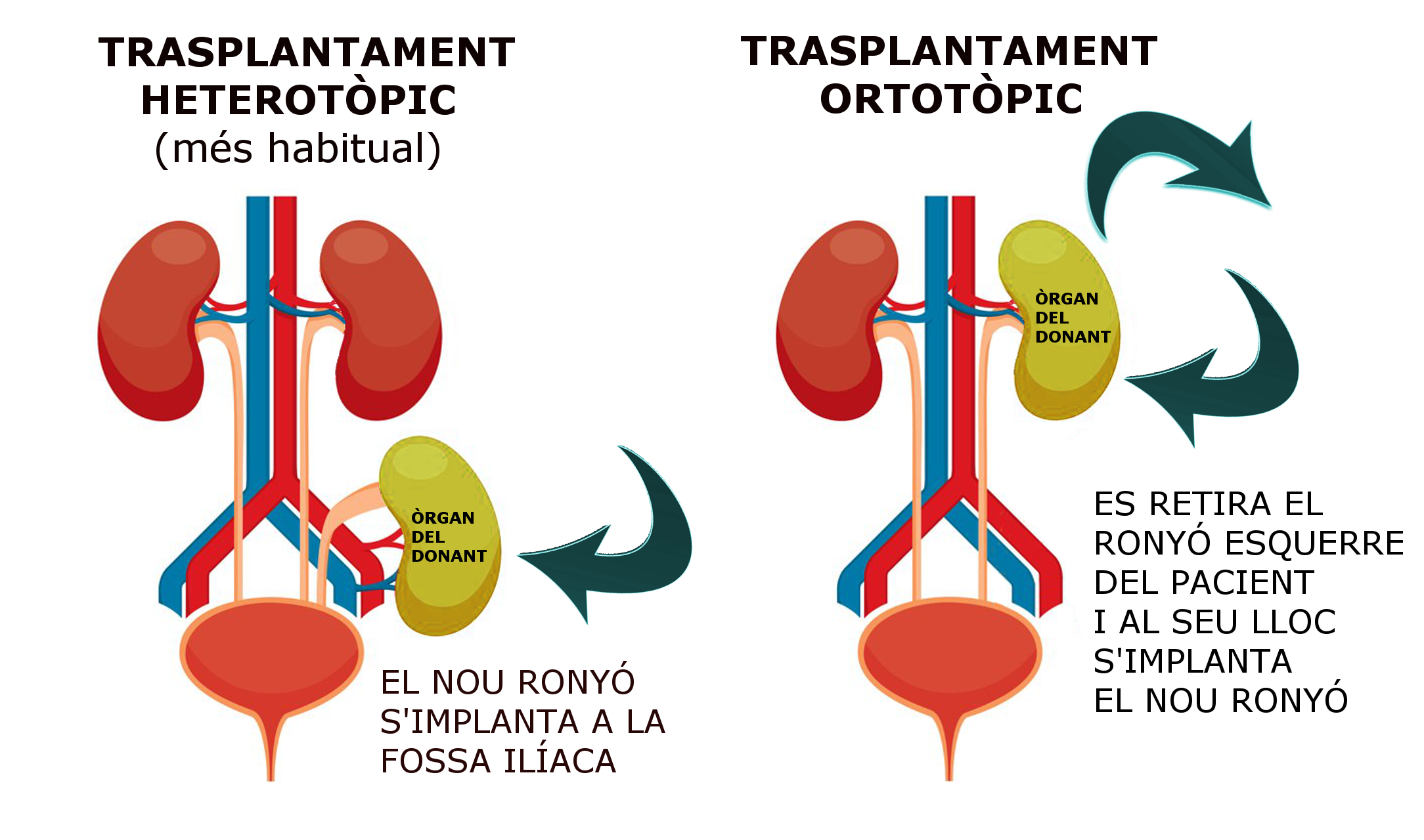 Trasplantament renal ortotòpic (esquema)