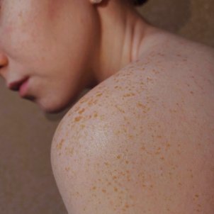 cumpleaños haz Foto Prevención y tratamientos para evitar las manchas en la piel por el sol
