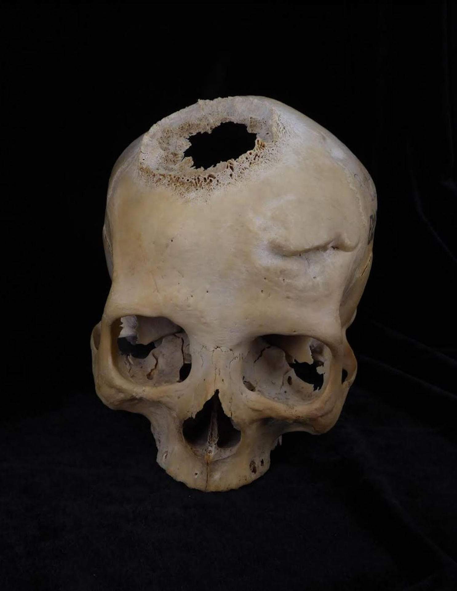 Un crani de 4.500 anys revela com els egipcis intentaven tractar el càncer