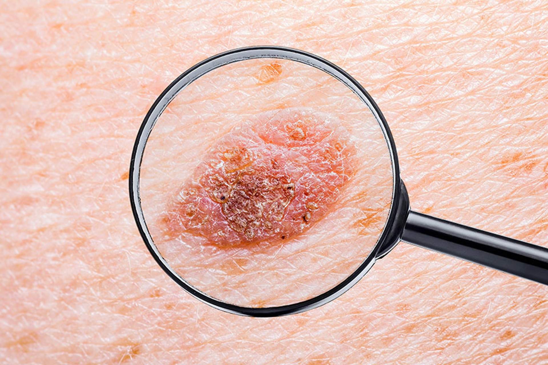 Una vacuna experimental contra el cáncer de piel reduce al 75% el riesgo de volver a tener un melanoma