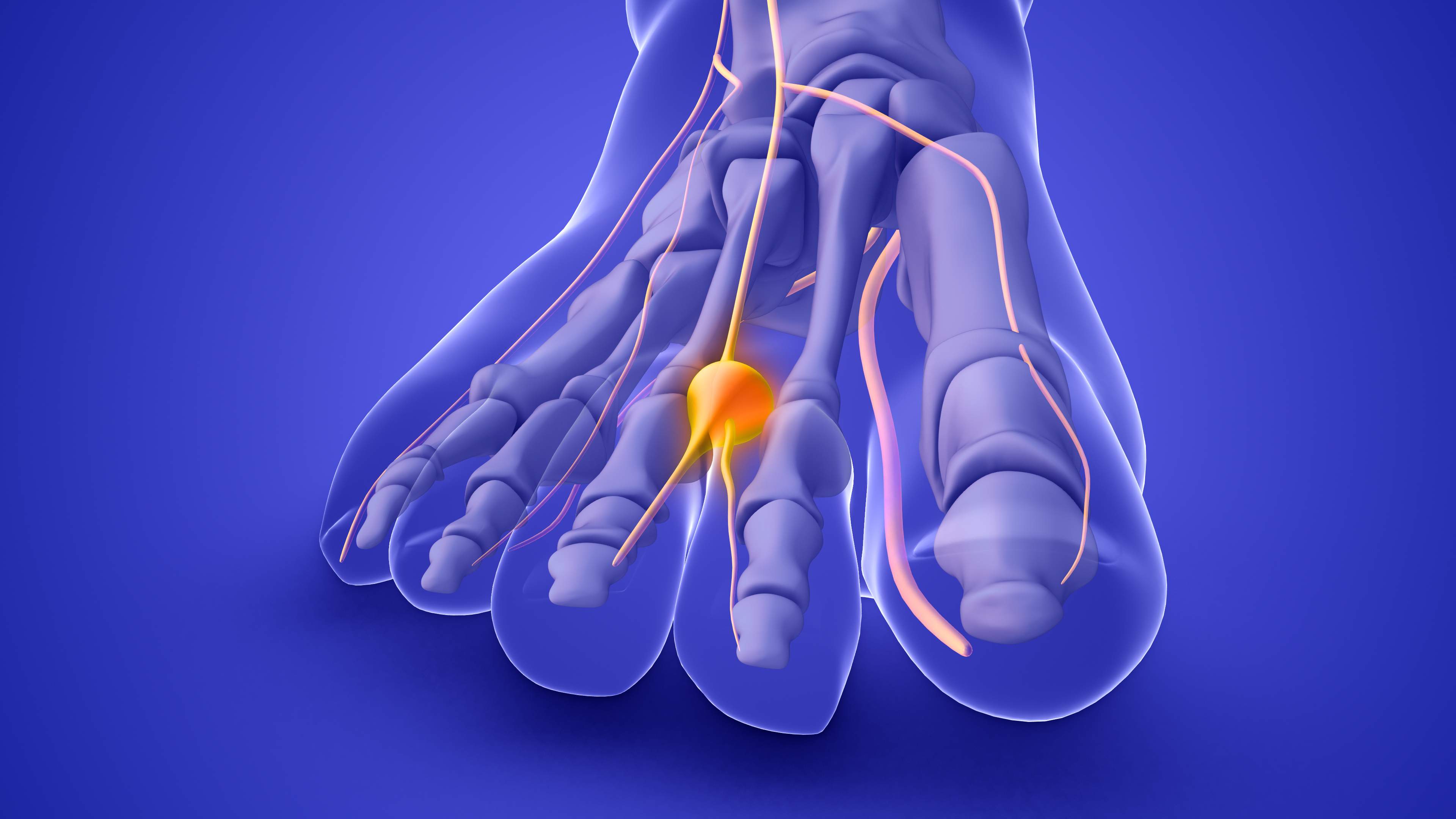 Todo lo que debes saber sobre el neuroma de Morton