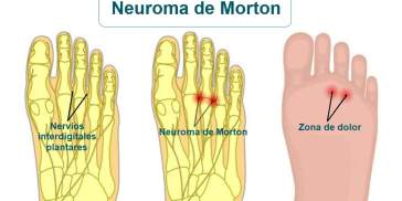 Neuroma de Morton fases