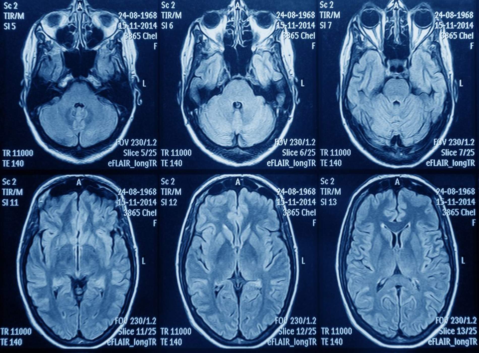 Astuce denuncia que pacients amb glioblastoma "lluiten contrarellotge per rebre un tractament"